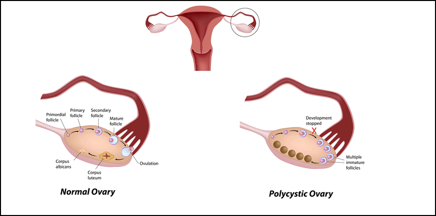 Best Infertility Treatment Specialist in Pune